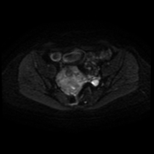 Adenoma malignum of cervix (Radiopaedia 66441-75705 Axial DWI 32).jpg