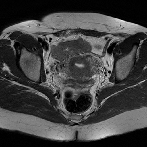 File:Adenomyosis-scar endometriosis (Radiopaedia 65863-75022 Axial T2 16).jpg