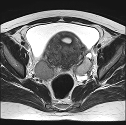 File:Adenomyosis - ovarian endometriomas (Radiopaedia 67031-76350 Axial T2 15).jpg