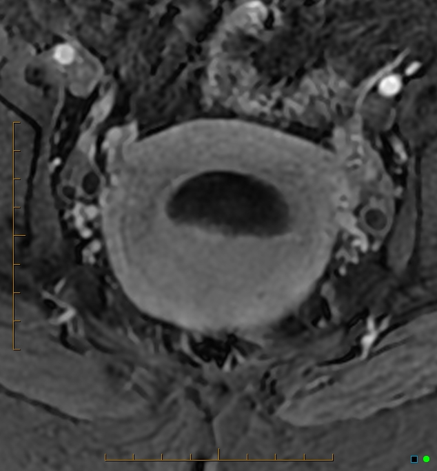 Adenomyosis uterus with hematometra (Radiopaedia 45779-50011 Axial T1 C+ fat sat 36).jpg
