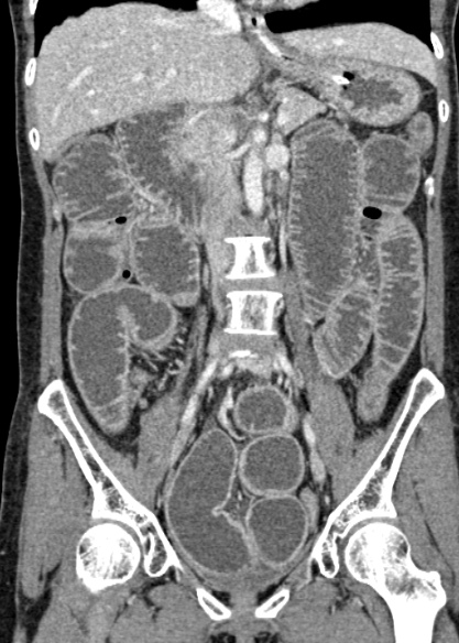 Adhesional small bowel obstruction (Radiopaedia 48397-53305 Coronal C+ portal venous phase 176).jpg