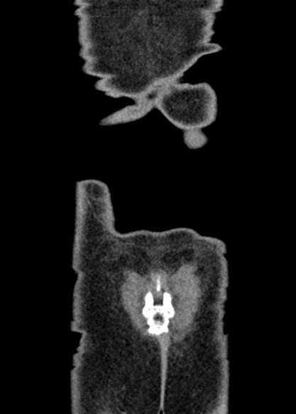 Adhesional small bowel obstruction (Radiopaedia 48397-53305 Coronal C+ portal venous phase 346).jpg