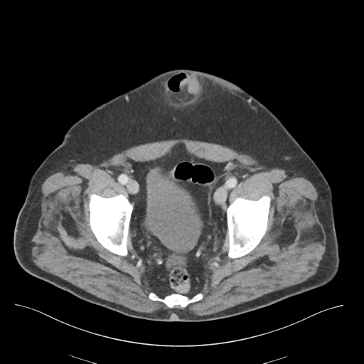 Adhesions within abdominal wall hernia (Radiopaedia 58283-65394 Axial C+ portal venous phase 75).png