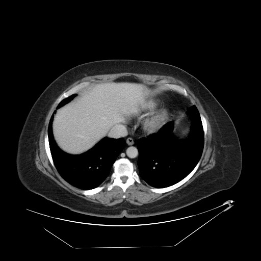 Adrenal angiosarcoma (Radiopaedia 81081-94671 Axial C+ portal venous phase 7).jpg