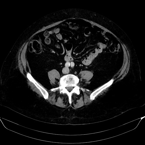 File:Adrenal cortical carcinoma (Radiopaedia 64017-72769 Axial C+ portal venous phase 46).jpg