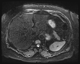 Adrenal cortical carcinoma (Radiopaedia 64017-72770 Axial DWI 7).jpg
