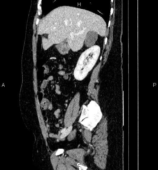 Adrenal cortical carcinoma (Radiopaedia 84882-100379 Sagittal C+ portal venous phase 28).jpg