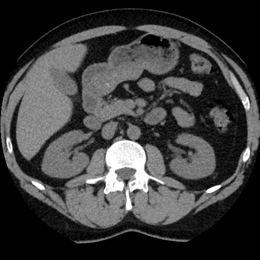 Adrenal gland trauma (Radiopaedia 81351-95079 Axial non-contrast 45).jpg