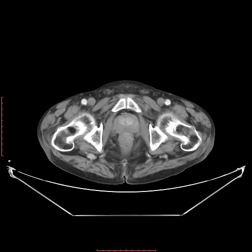 Adrenal hemangioma (Radiopaedia 68923-78668 Axial C+ portal venous phase 71).jpg