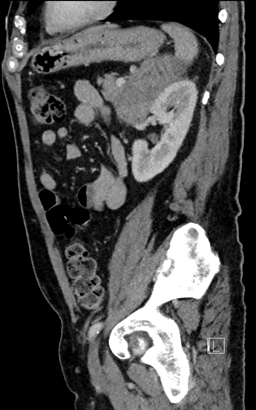 Adrenal lymphoma (Radiopaedia 73730-84529 Sagittal C+ portal venous phase 78).jpg