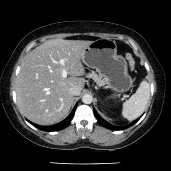 Adrenal myelolipoma (Radiopaedia 43401-46759 Axial C+ portal venous phase 19).jpg