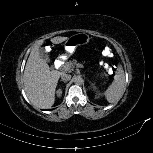 Adrenal myelolipoma (Radiopaedia 84319-99617 Axial With oral contrast 68).jpg