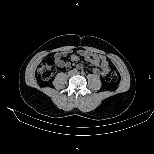 Adrenal myelolipoma (Radiopaedia 87794-104246 Axial non-contrast 64).jpg