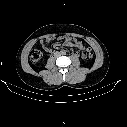 Adrenal myelolipoma (Radiopaedia 87794-104246 Axial renal excretory phase 56).jpg