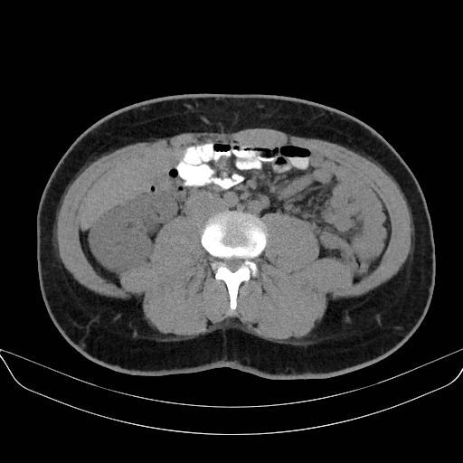 Adrenal myelolipoma - bilateral (Radiopaedia 74805-85810 Axial non-contrast 44).jpg