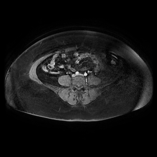 File:Adult granulosa cell tumor of the ovary (Radiopaedia 64991-73953 axial-T1 Fat sat post-contrast dynamic 73).jpg