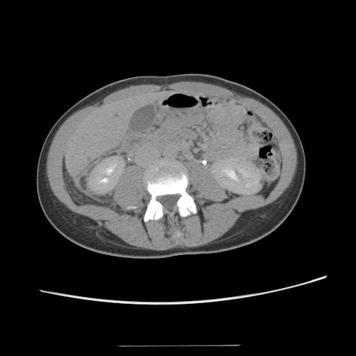 File:Adult polycystic kidney disease (Radiopaedia 48845-53876 Axial renal excretory phase 50).jpg