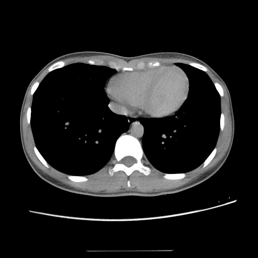 File:Adult polycystic kidney disease (Radiopaedia 48845-53876 Axial renal excretory phase 9).jpg