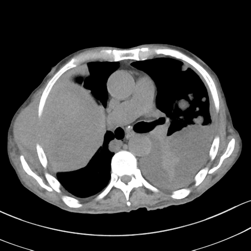 Advanced metastatic lung cancer (Radiopaedia 48910-53954 Axial non-contrast 31).png