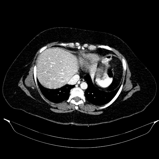 File:Afferent loop syndrome - secondary to incarcerated trocar site hernia (Radiopaedia 82959-97305 Axial C+ portal venous phase 27).jpg