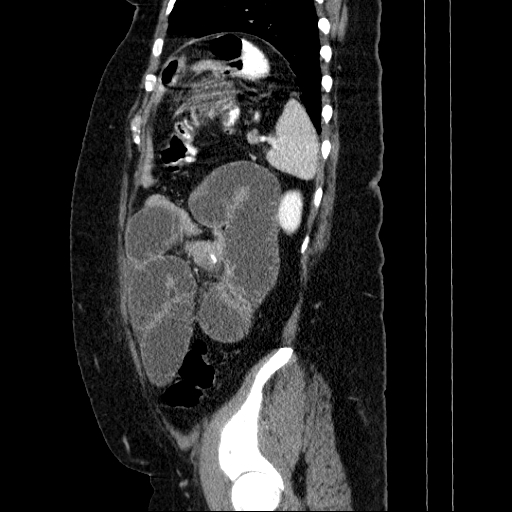 File:Afferent loop syndrome - secondary to incarcerated trocar site hernia (Radiopaedia 82959-97305 Sagittal C+ portal venous phase 34).jpg