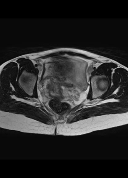 File:Aggressive angiomyxoma of the pelvis and perineum (Radiopaedia 59162-66479 Axial T2 10).jpg