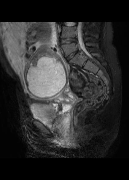 File:Aggressive angiomyxoma of the pelvis and perineum (Radiopaedia 59162-66479 Sagittal T2 fat sat 13).jpg