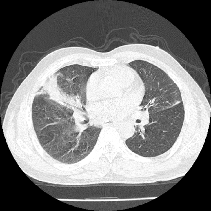 Airway foreign body in adult (Radiopaedia 85907-101779 Axial lung window 95).jpg