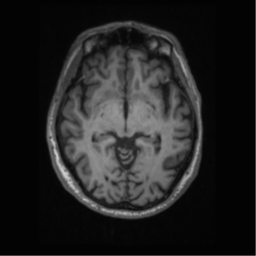 Alzheimer disease - probable (Radiopaedia 35334-36837 Axial T1 36).png