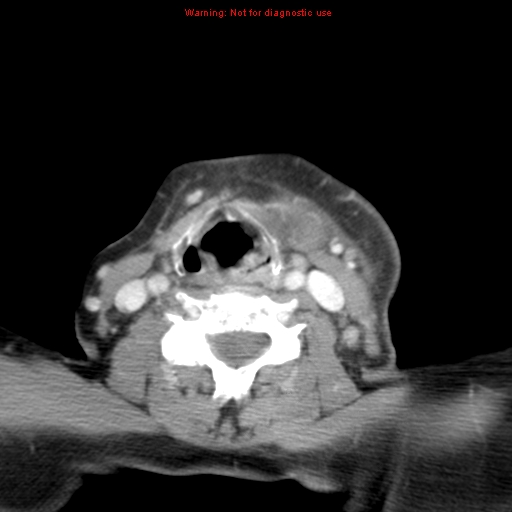 Ameloblastoma (Radiopaedia 27437-27631 A 62).jpg