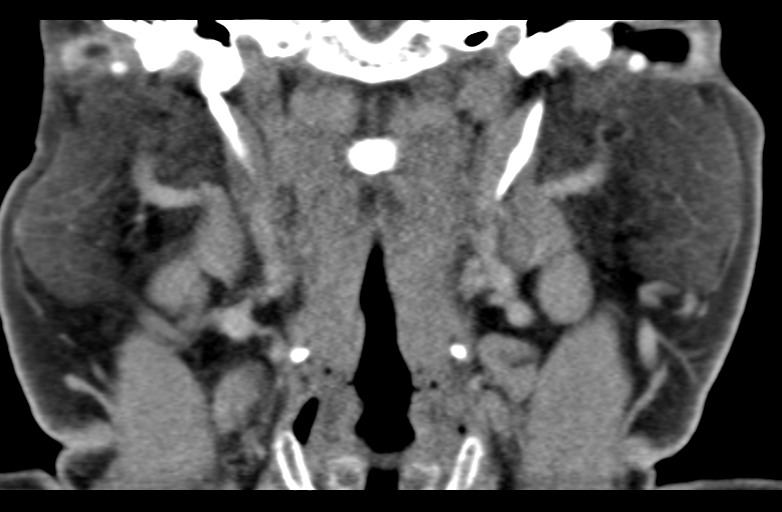 Ameloblastoma (Radiopaedia 33677-34806 Coronal non-contrast 42).png