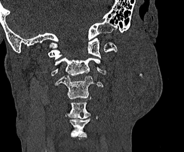 Ameloblastoma (Radiopaedia 51921-57766 Coronal bone window 236).jpg