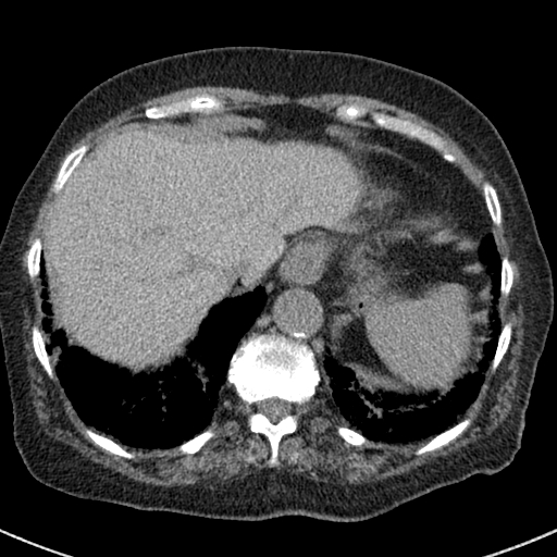 File:Amiodarone-induced pulmonary fibrosis (Radiopaedia 82355-96460 Axial non-contrast 51).jpg