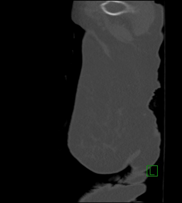 Amiodarone deposition in the liver (Radiopaedia 77587-89780 Sagittal bone window 1).jpg