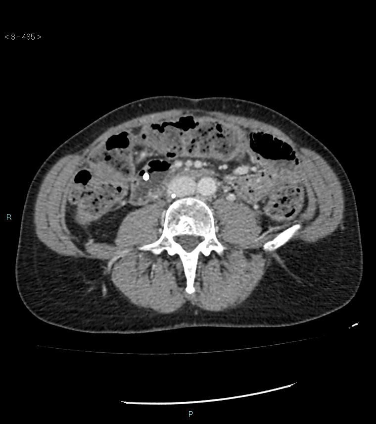 Ampulla of Vater metastasis (Radiopaedia 27820-28069 A 123).jpg