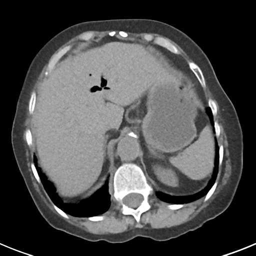 File:Ampullary adenocarcinoma (Radiopaedia 34013-35237 Axial non-contrast 10).png