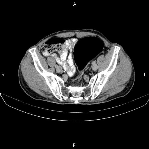 Ampullary adenocarcinoma (Radiopaedia 86093-102032 Axial C+ delayed 85).jpg