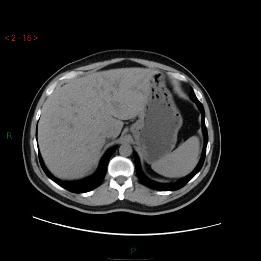 File:Ampullary carcinoma (Radiopaedia 56396-63056 Axial non-contrast 11).jpg