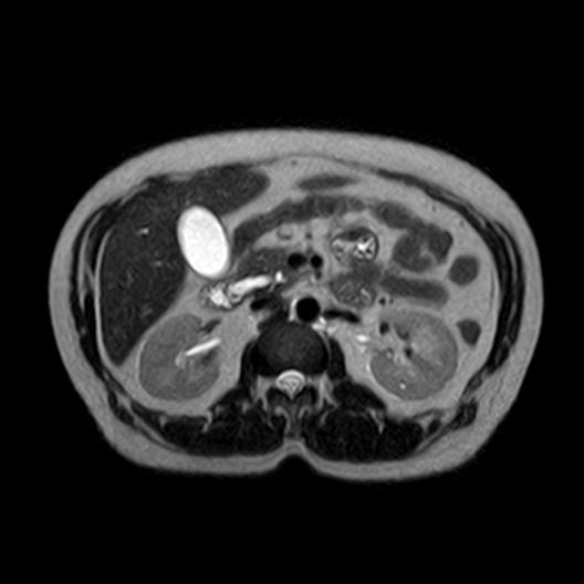 File:Ampullary tumor (Radiopaedia 27294-27479 T2 7).jpg