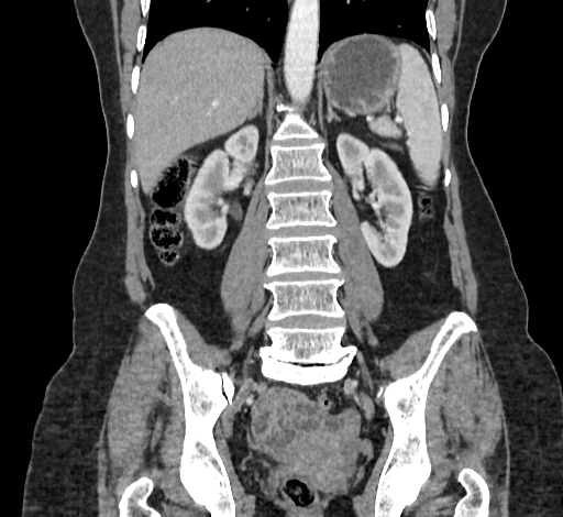 File:Ampullary tumor (Radiopaedia 60333-67998 B 50).jpg