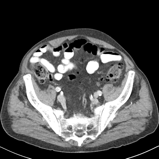 File:Amyand hernia (Radiopaedia 39300-41547 A 55).png