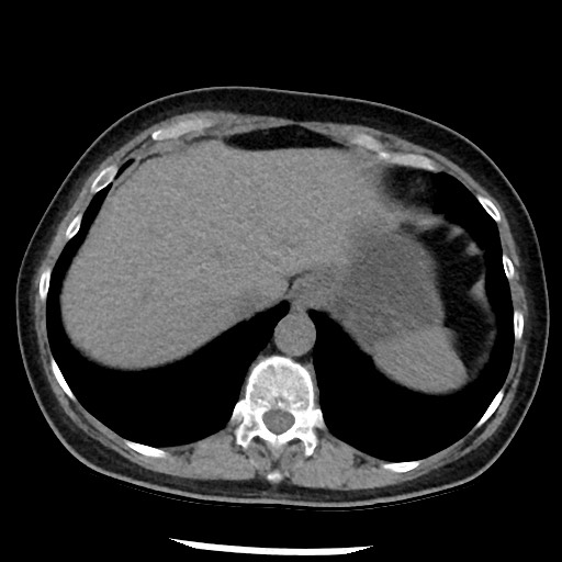 Amyloidosis - bronchial and diffuse nodular pulmonary involvement (Radiopaedia 60156-67744 Axial non-contrast 50).jpg