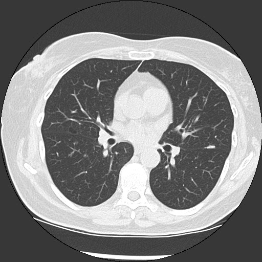 Amyloidosis - bronchial and diffuse nodular pulmonary involvement (Radiopaedia 60156-67744 B 29).jpg