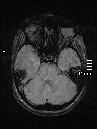 Amyotrophic lateral sclerosis (Radiopaedia 70821-81017 Axial SWI 12).jpg