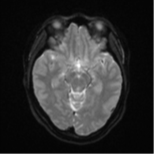 Anaplastic astroblastoma (Radiopaedia 55666-62194 Axial DWI 12).png