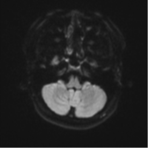 Anaplastic astroblastoma (Radiopaedia 55666-62194 Axial DWI 34).png