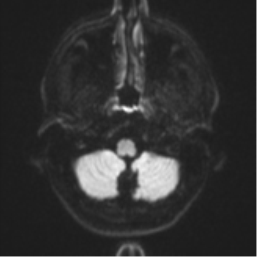Anaplastic astrocytoma (Radiopaedia 57768-64731 Axial DWI 31).png
