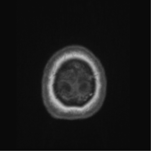 Anaplastic astrocytoma IDH wild-type (pseudoprogression) (Radiopaedia 42209-45276 Axial T1 145).png