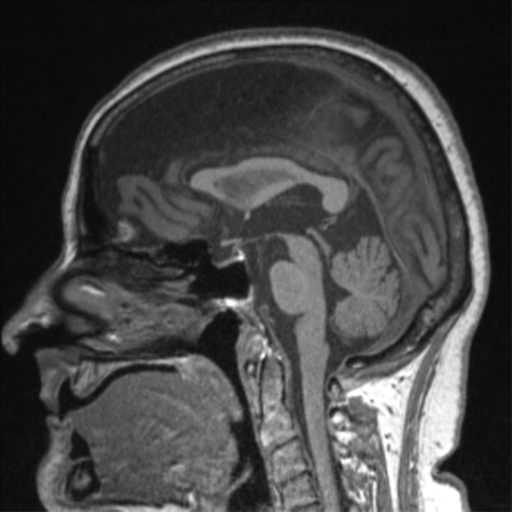 File:Anaplastic astrocytoma IDH wild-type (pseudoprogression) (Radiopaedia 42209-45276 Axial T1 153).png