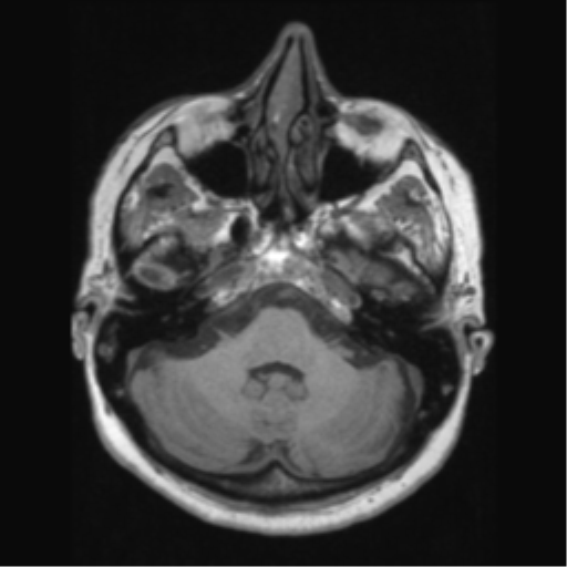 File:Anaplastic astrocytoma IDH wild-type (pseudoprogression) (Radiopaedia 42209-45276 Axial T1 41).png